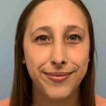 Nose Surgery Before & After Patient #11032
