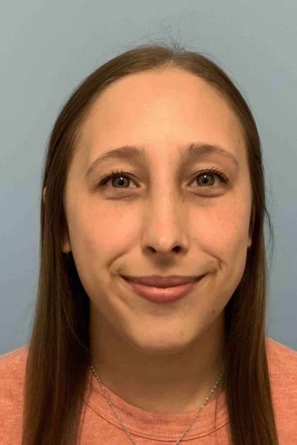 Nose Surgery Before & After Patient #11032