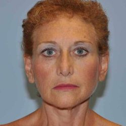 Neck Lift Before & After Patient #11046