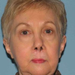 Neck Lift Before & After Patient #11104