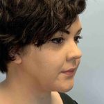 Neck Lift Before & After Patient #11120