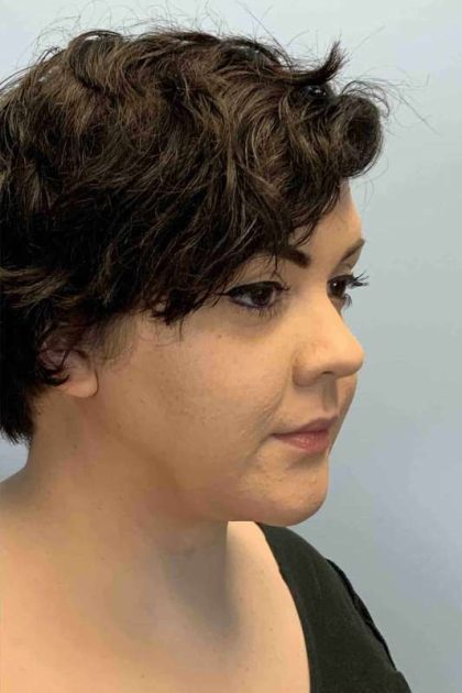 Neck Lift Before & After Patient #11120