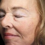Neck Lift Before & After Patient #11127