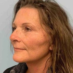 Neck Lift Before & After Patient #11134