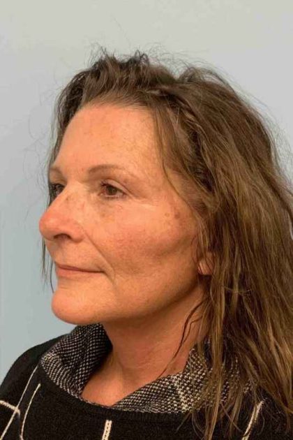 Neck Lift Before & After Patient #11134