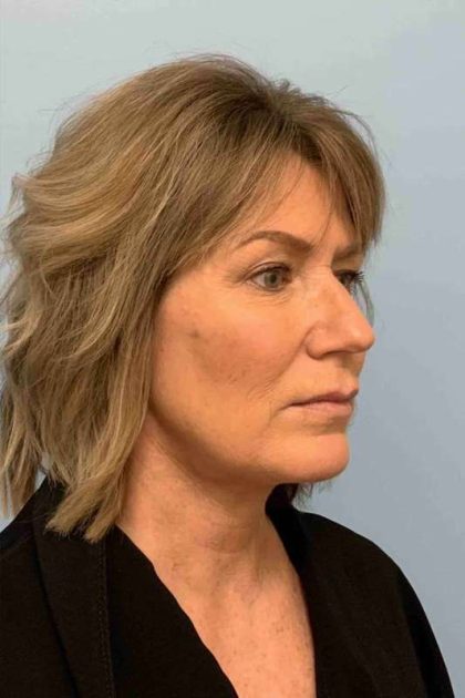 Neck Lift Before & After Patient #11145