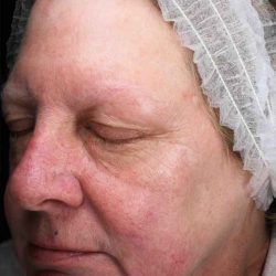 Laser Resurfacing Before & After Patient #11182