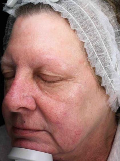 Laser Resurfacing Before & After Patient #11182