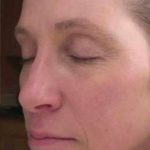 Laser Resurfacing Before & After Patient #11215
