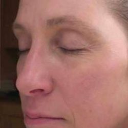 Laser Resurfacing Before & After Patient #11215