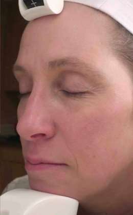 Laser Resurfacing Before & After Patient #11215