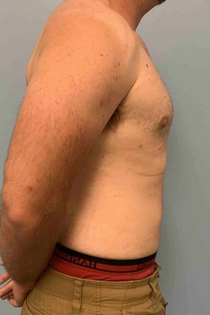 Gynecomastia Before & After Patient #11237