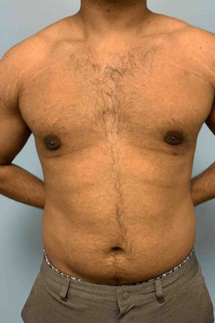Gynecomastia Before & After Patient #11253