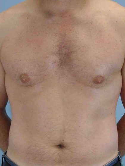 Gynecomastia Before & After Patient #11260