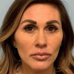 Fillers Before & After Patient #11283