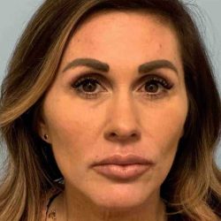 Fillers Before & After Patient #11283