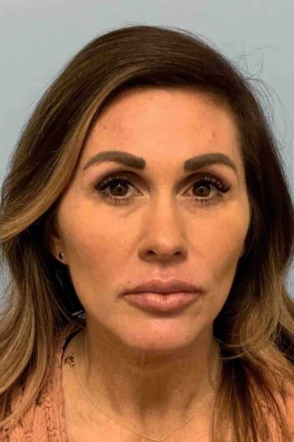 Fillers Before & After Patient #11283