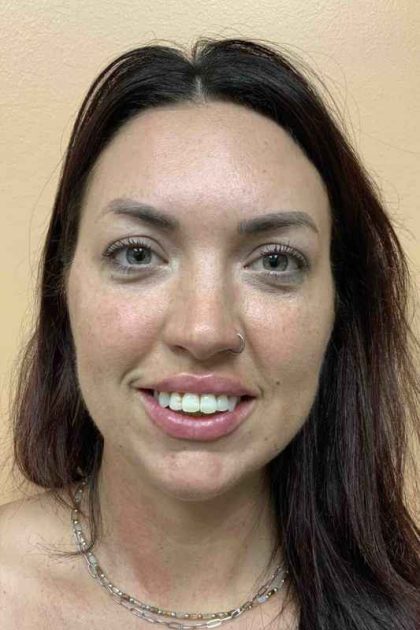 Fillers Before & After Patient #11298