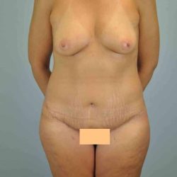 Fat Injections Before & After Patient #11333