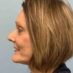 Fat Injections Before & After Patient #11347