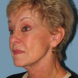 Facelift Before & After Patient #11364
