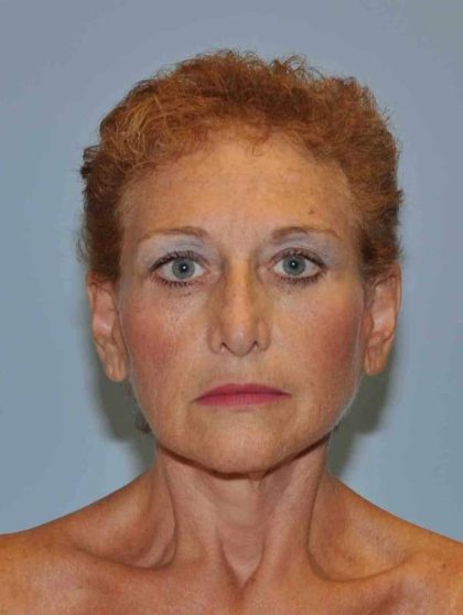 Facelift Before & After Patient #11371
