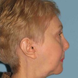 Facelift Before & After Patient #11403