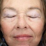 Facelift Before & After Patient #11410