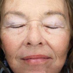 Facelift Before & After Patient #11410