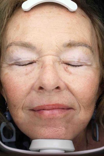 Facelift Before & After Patient #11410
