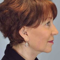 Facelift Before & After Patient #11417
