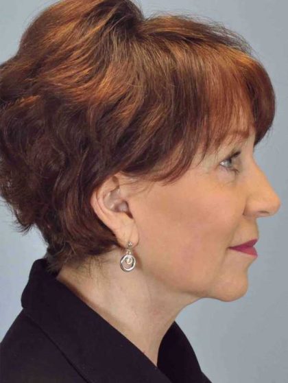 Facelift Before & After Patient #11417