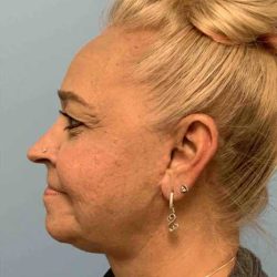 Facelift Before & After Patient #11424