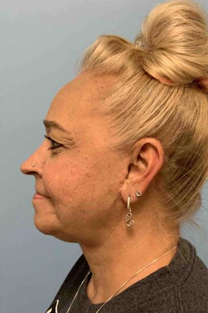 Facelift Before & After Patient #11424