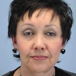 Facelift Before & After Patient #11431