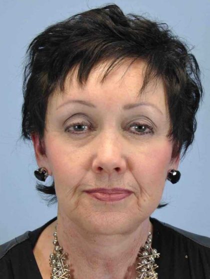Facelift Before & After Patient #11431