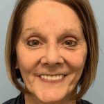 Facelift Before & After Patient #11443