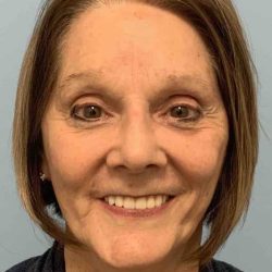 Facelift Before & After Patient #11443