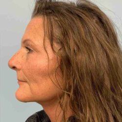 Facelift Before & After Patient #11450