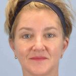 Facelift Before & After Patient #11457