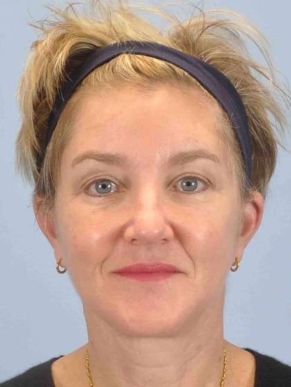 Facelift Before & After Patient #11457