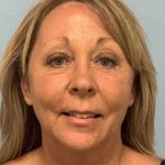 Eyelid Surgery Before & After Patient #11464