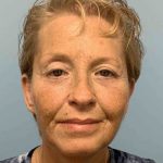 Eyelid Surgery Before & After Patient #11476