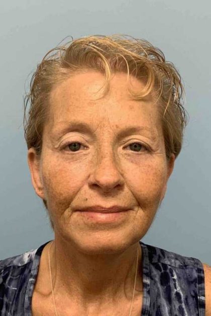 Eyelid Surgery Before & After Patient #11476