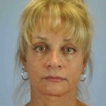 Eyelid Surgery Before & After Patient #11490