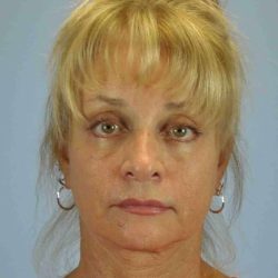 Eyelid Surgery Before & After Patient #11490