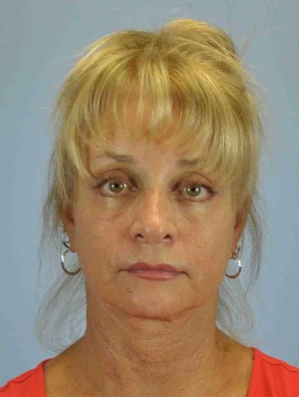 Eyelid Surgery Before & After Patient #11490