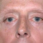 Eyelid Surgery Before & After Patient #11497