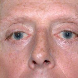 Eyelid Surgery Before & After Patient #11497
