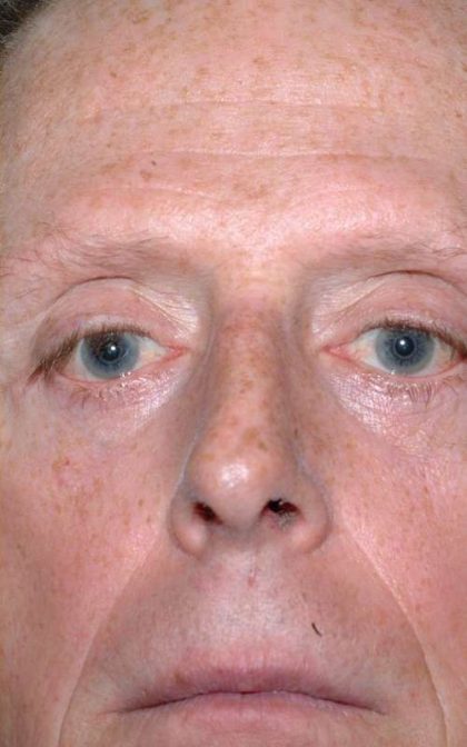 Eyelid Surgery Before & After Patient #11497